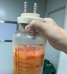 固始水动力吸脂手术要做多久？